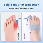 Bunion Corrector Unisex Big Toe Orthopedic Toe Straightener Anti-Slip Heel Strap for Left & Right Feet Rotatable Toe Separator